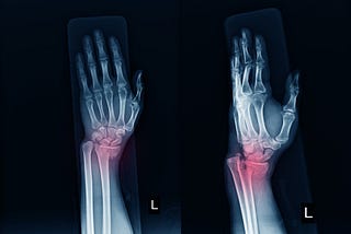 AI in fracture detection- A technical perspective to solve the problem
