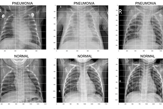 Pneumonia Detection From X-ray Images Using Deep Learning Neural Network