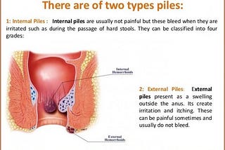 When to see your doctor about your hemorrhoids