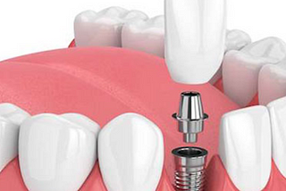 Why Dental Implant Services Are The Best Solution For Missing Teeth?