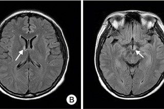 Revolutionizing TBI Through Connectograms