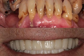 All-on-4/6 Same-day Implants