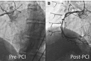 How can we reduce our risk of having a heart attack?