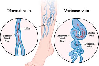 Leading Lymphedema Therapy Clinic in MN | Minnesota Vein Center