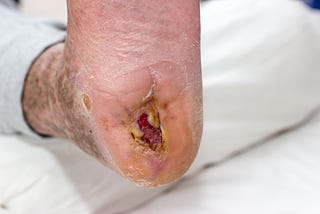 Here’s Why Diabetic Foot Ulcers Remain An Existential Threat For Diabetics — Even When Using…
