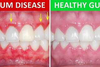 Gum Disease May Put People At High Risk Of Developing Some Cancers