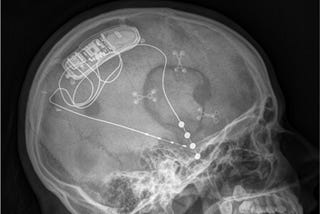 Responsive Neurostimulation and the rise of real-time, personalized medicine