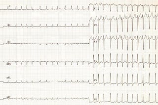 How a Silent Heart Disturbance May Signal You Have Sleep Apnea