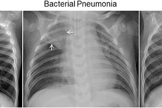 Pneumonia Diagnosis using CNN’s