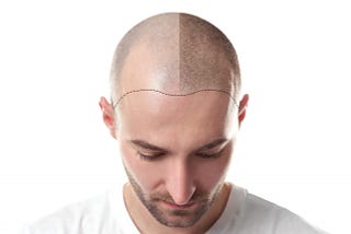 Top Non-Surgical Hair Restoration Techniques Available in Concord