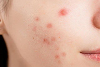 Sudden Active Acne: What You Need to Know | Skin Solution 1O1
