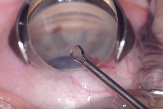 Complex Cases, Simplified (4): Simplifying MIGS Micro Stent Revision Surgery