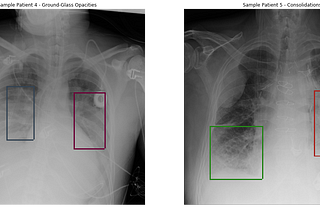Pneumonia Detection from chest radiograph (CXR)