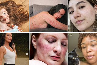 ​SKIN GETS REAL WITH SOCIAL MEDIA’S #SKINPOSITIVITY MOVEMENT