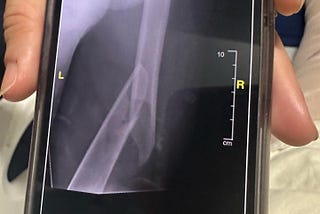 I snapped my femur rock climbing, now what?