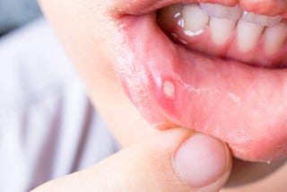 Top 3 mouth ulcer treatments