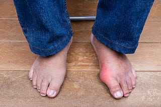 What Can Happen If Gout is Left Untreated for Too Long