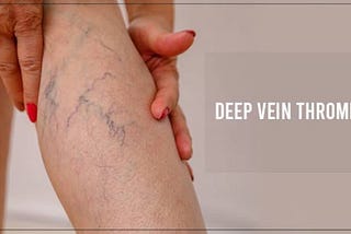 Ditch the Clot! Simple Steps to Prevent Deep Vein Thrombosis (DVT)