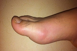 Gout Home Remedies, Diet, Treatments, Symptoms & Medications