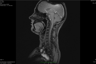 Functional MRI for Major Depressive Disorder