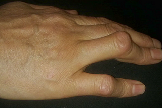 How to improve rheumatic arthritis with supplements?