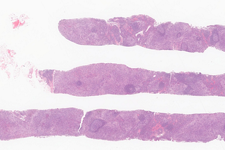 Dermatopathic Lymphadenopathy