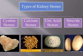 A Quick Guide On Kidney Stones And Their Types