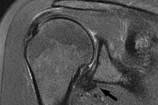 Frozen Shoulder Healing