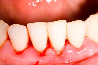 How to stop gums from bleeding?