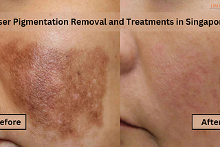 Skin hyperpigmentation treatment in Singapore.