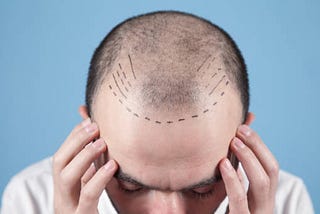All The Details You Need To Have Before Considering A Hair Transplant In Delhi