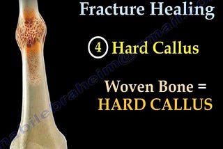 Fracture Healing: Comprehensive Insights into the Stages, Types, and Influencing Factors