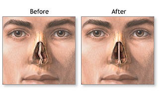 What to expect from Deviated Septum Surgery (Septoplasty)