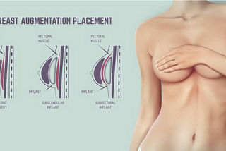 breast-augmentation-ahmet-dilber