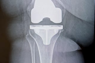 An X-ray reveals a knee joint with a visible prosthetic implant in place, highlighting the alignment and structure of the femur and tibia. The details of the metal implant are clearly contrasted against the surrounding bone and tissue.