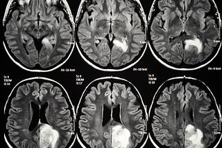 Glioblastoma Multiforme is an incurable and devastating brain cancer