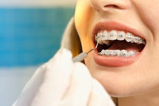 What is the Most Painful Day of Braces? A Complete Breakdown