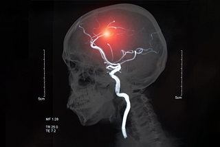 What causes a stroke and why does it happen? [Infographic]