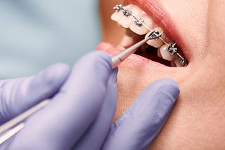 best metal braces treatment in rajkot