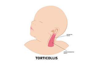 Understanding Torticollis: Causes, Symptoms, And Management