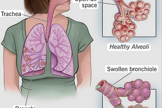 Topic: Understanding Pneumonia: Symptoms, Causes, and Treatment.