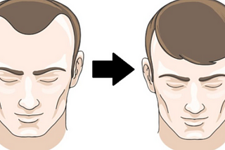 How Hair Transplant for men can change comments about personality?