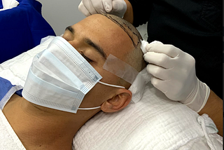 Advantages of hair transplant with the FUE technique