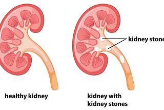 What are the potential complications of untreated kidney stones?