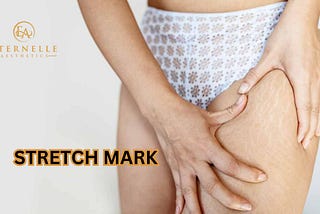 Minimize the Appearance of Stretch Marks During Pregnancy With 3 Tips