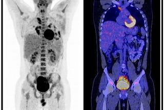 A young male with lymphoma contracting Covid-19