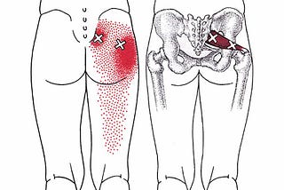 Piriformis Sendromu