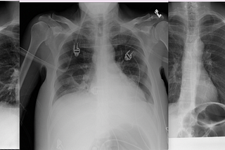 Multi-category classification of various chest conditions from chest x-rays
