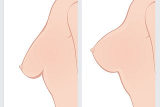 How Much Is Breast Uplift?