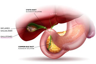 Gallstone Treatment in Mumbai — Globus Gastroenterology Hospital